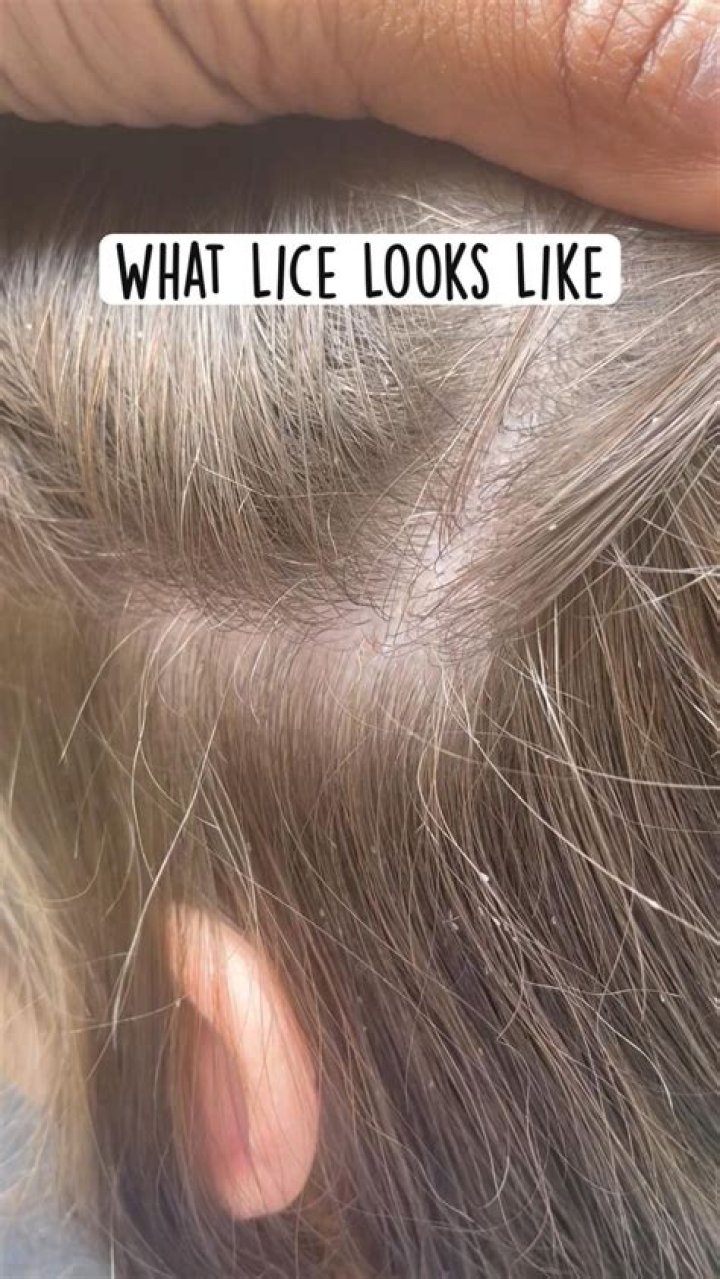 Can book lice live in your hair?