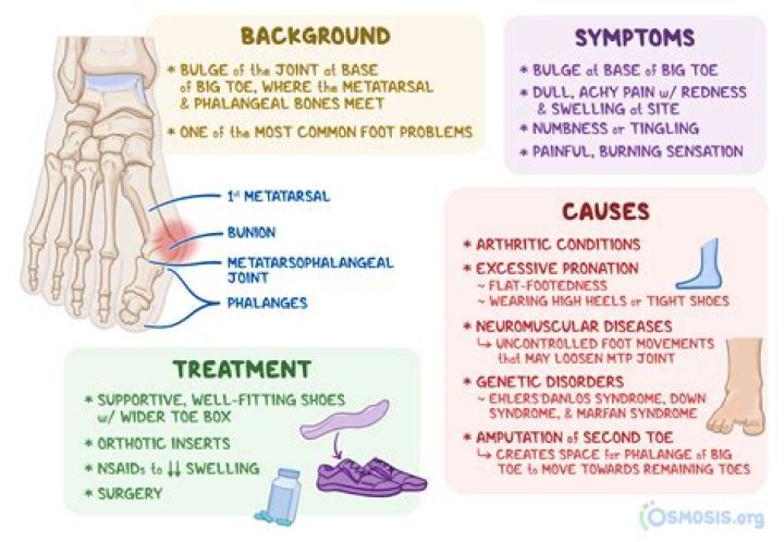 Can weight cause bunions?