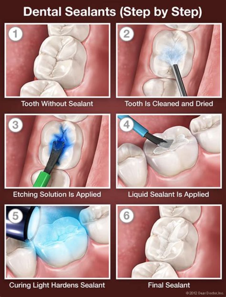 Can you put sealant over filling?