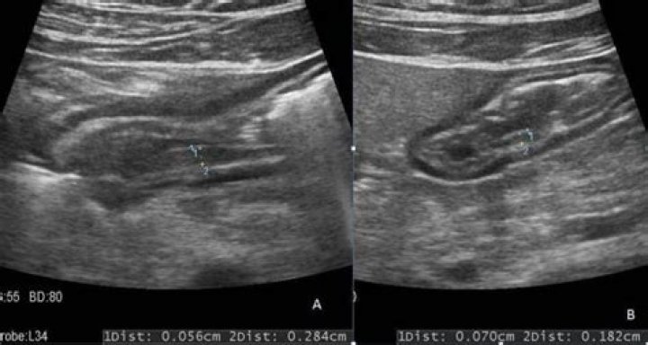 Can you see gastritis on ultrasound?