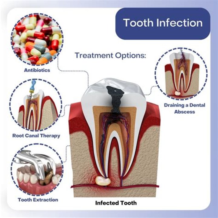 Do antibiotics help nerve pain in tooth?