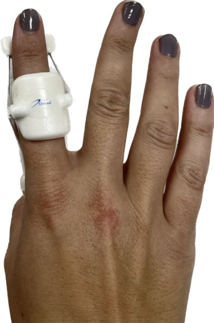 Do finger splints work?