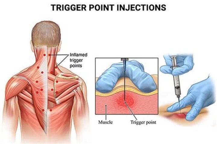 Do physical therapists do trigger point injections?