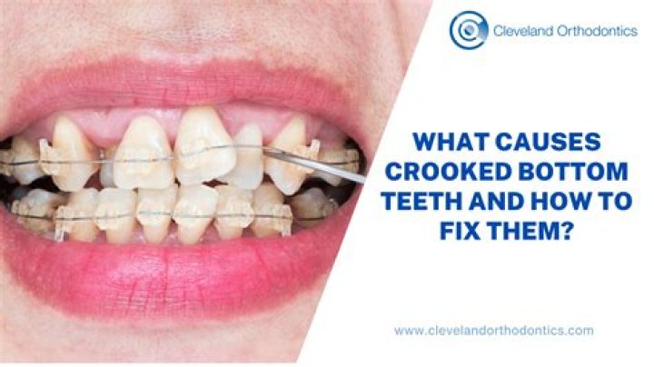 Do teeth get more crooked as you age?