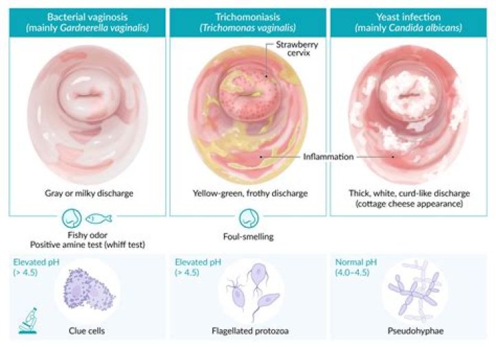 Does trichomoniasis mean my partner cheated?