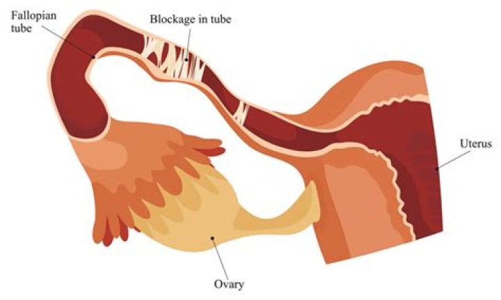 Has anyone got pregnant with blocked fallopian tubes?