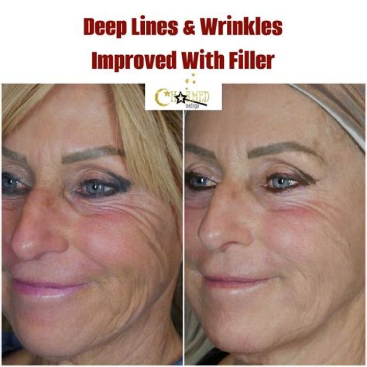 How can I hide deep facial wrinkles?