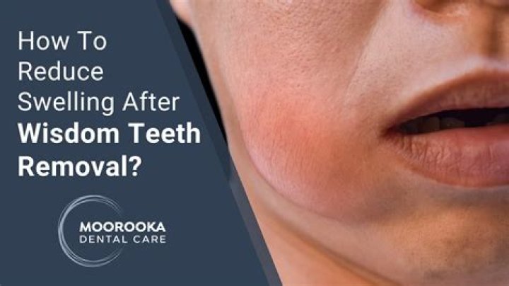 How do you reduce swelling in your face from a toothache?