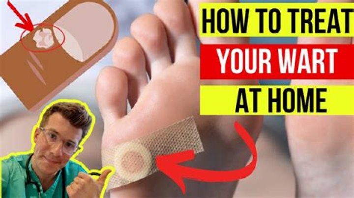How do you remove a deep wart?