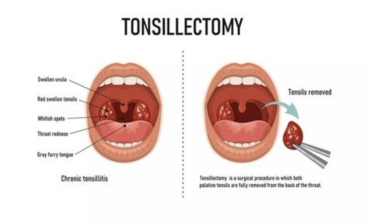 How do you sleep after a tonsillectomy?