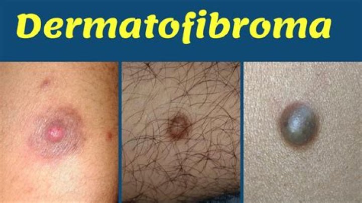 How fast does dermatofibroma grow?