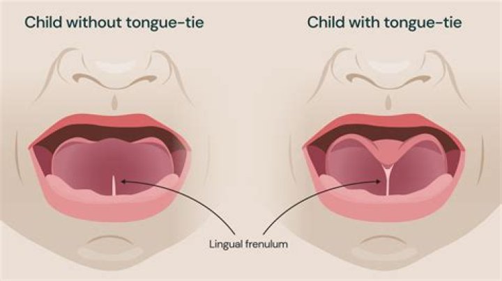 How long does it take tongue-tie to reattach?