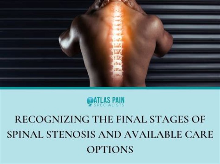 How many stages of spinal stenosis are there?