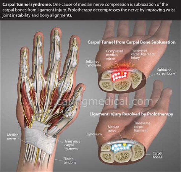 Is carpal tunnel syndrome Permanent?