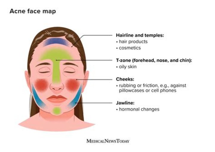 Is cheek acne hormonal?