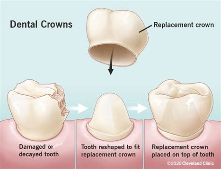 Should a crown hurt when you bite down?