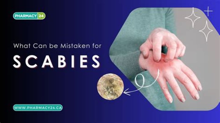 What can be mistaken for meningitis?