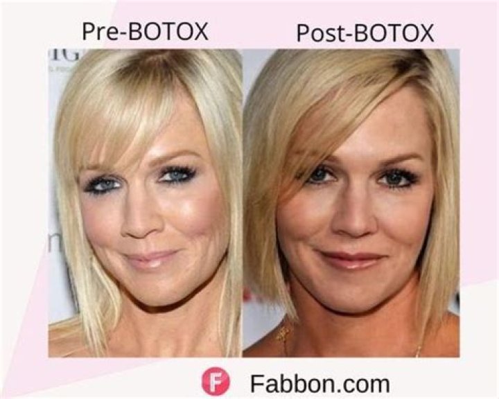 What celebrities have had Botox?