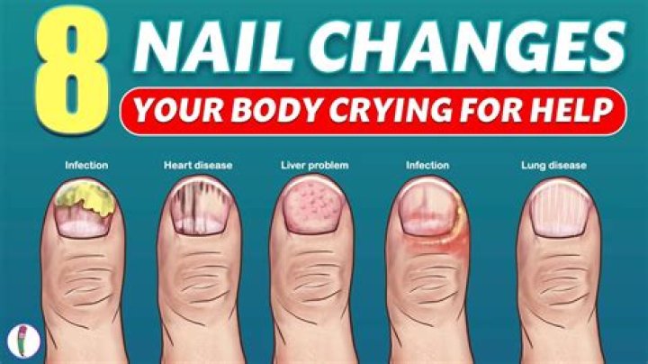 What do your nails look like if you have thyroid problems?