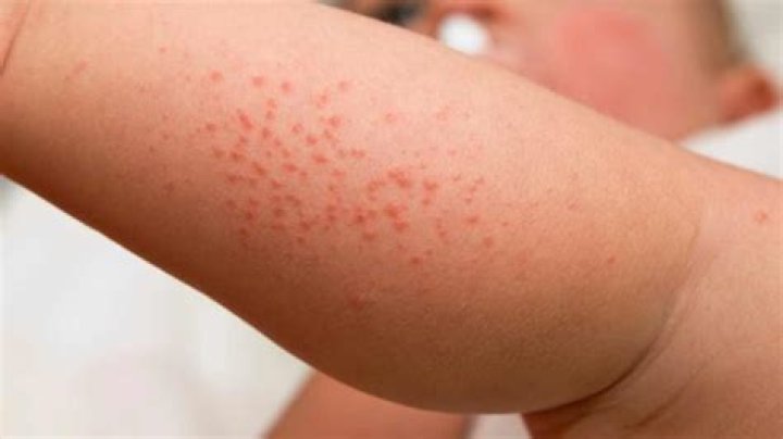 What does a hormonal rash look like?