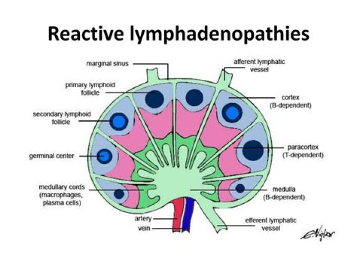 What is a reactive lymph node?