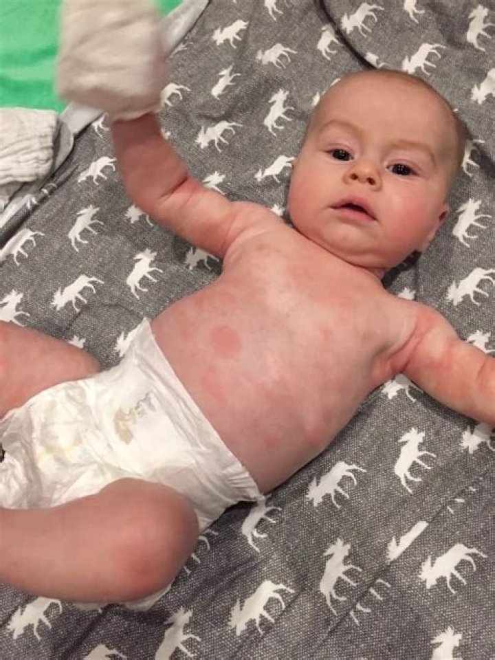 What is milk rash baby?