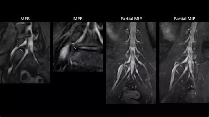 What will an MRI show for lower back pain?