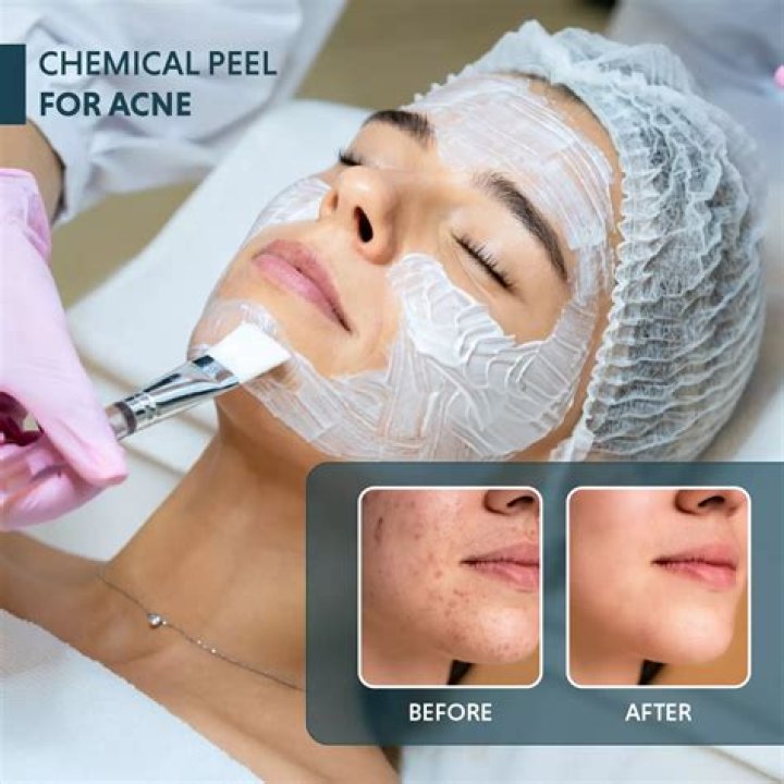 Which peel is best for skin tightening?