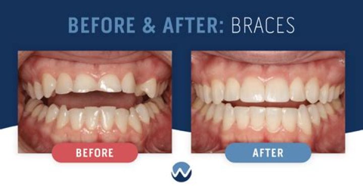 Who can wear invisible braces?