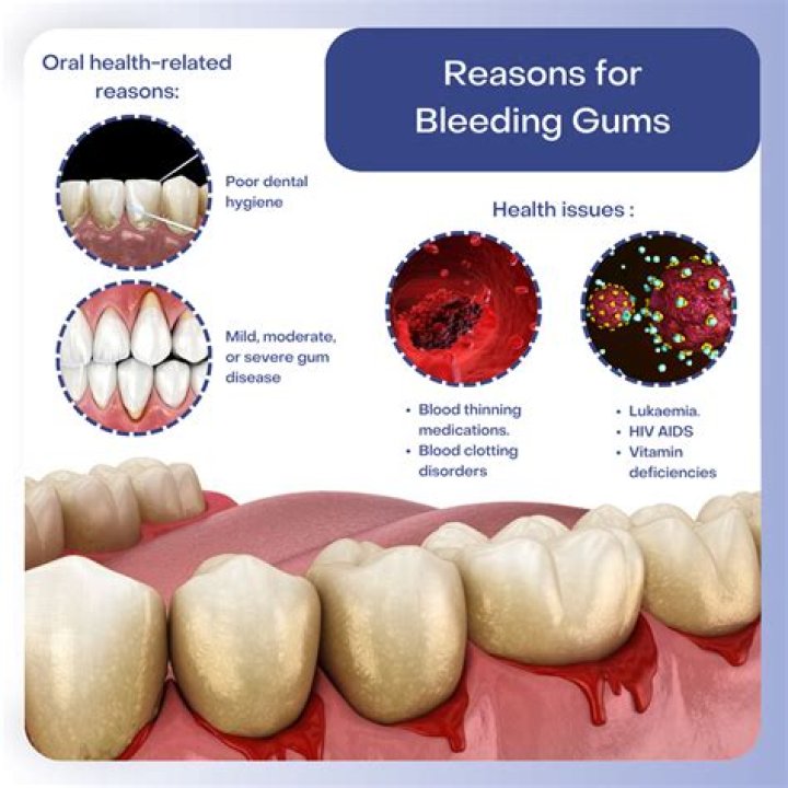 Why does my gum graft keep failing?