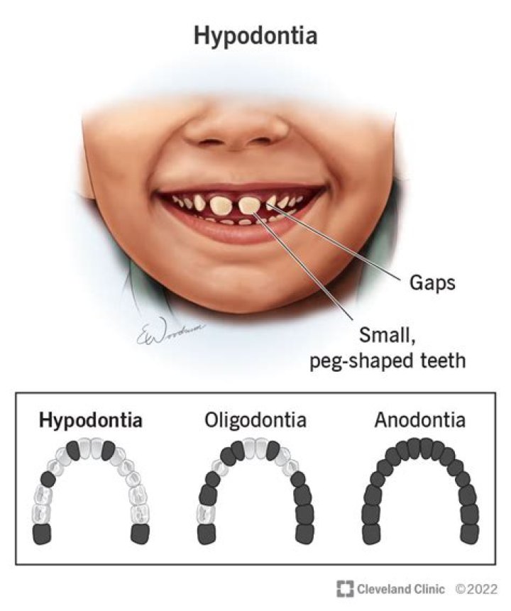 Why would a child have black teeth?